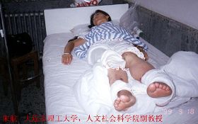 被生鏽的腳鐐磨破的腳腕開始紅腫化膿並開始發高燒