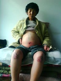 孫福娣被迫害致腹水重症