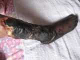 宋會蘭被打毒針迫害後，腿腳變黑、小腿腐爛（慎入）。