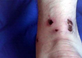 圖為張國立腳腕被腳鐐銬磨留下的傷痕