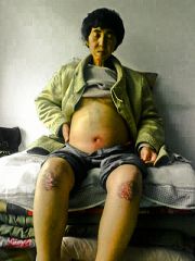 被迫害致嚴重腹水腫的孫福弟