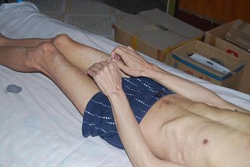 '肋部被鞋刷子搗爛感染，全身肌肉萎縮體重不足90斤'