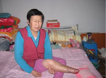 宋會蘭的右腳掉落，成殘疾