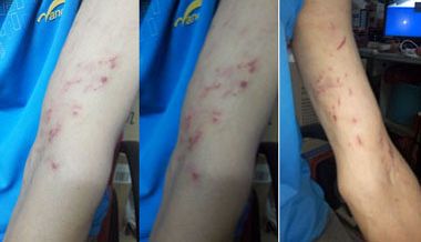 郭倡材雙手臂被銬腫、銬傷