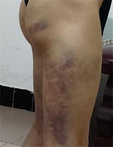 '鄧傳久被打傷的照片'